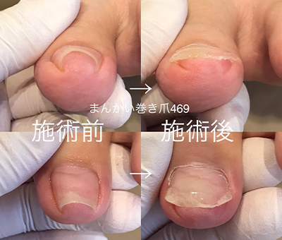 施術前後の巻き爪写真を共有